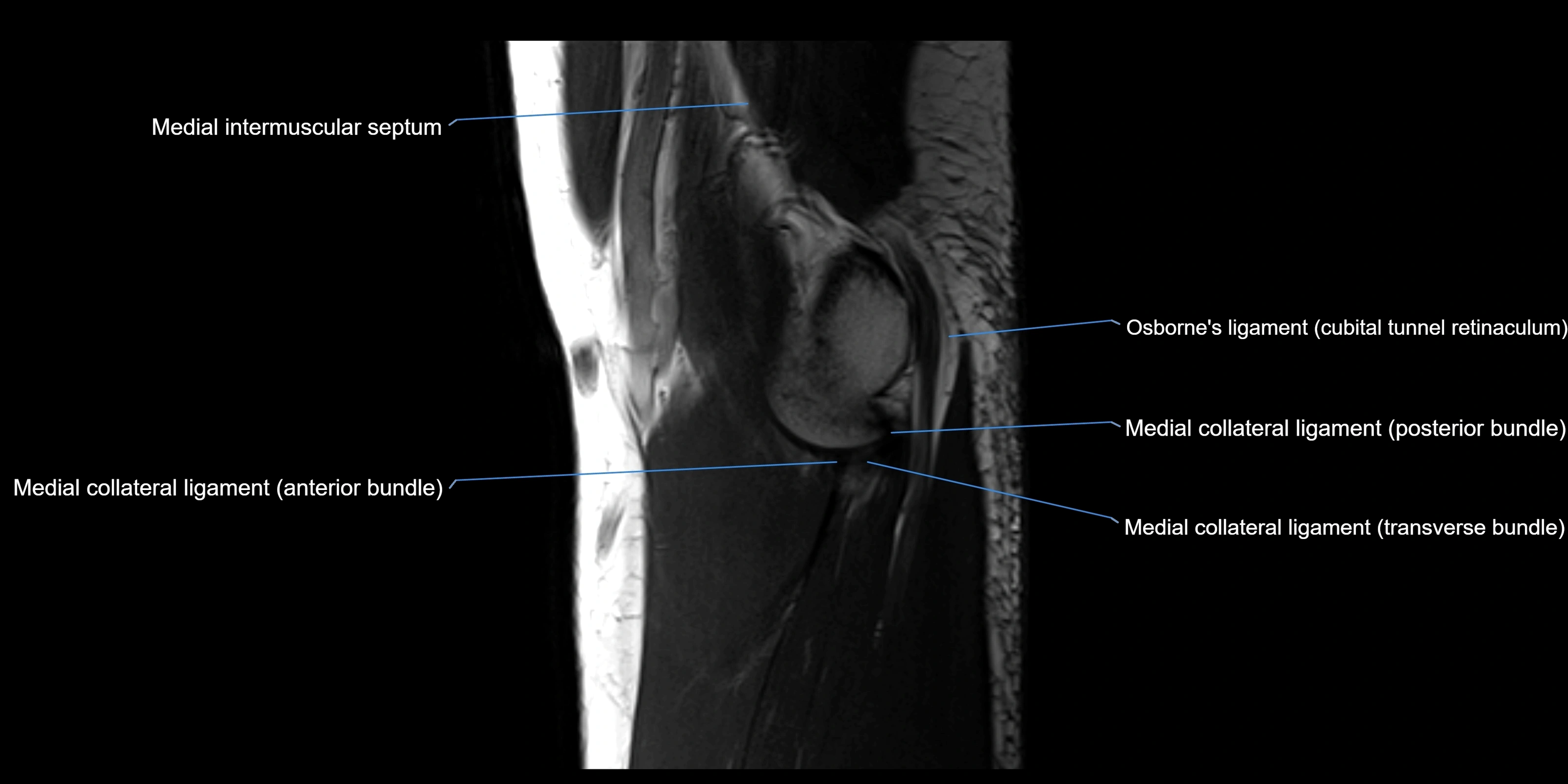 MRI elbow sagittal cross sectional anatomy 3T radiology  image-img-00001-00009.webp